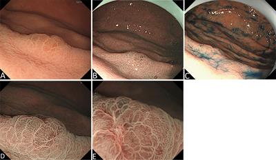 Endoscopic and pathohistologic features of early gastric signet ring cell carcinoma presented as elevated type: A case report